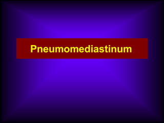 Pneumomediastinum
 