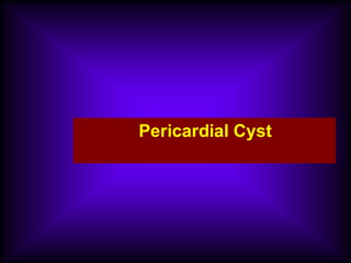Pericardial Cyst
 