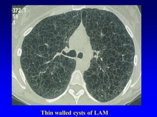 Thin walled cysts of LAM
 