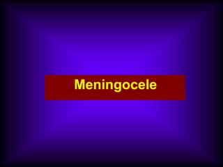 Meningocele
 