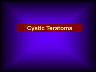 Cystic Teratoma
 
