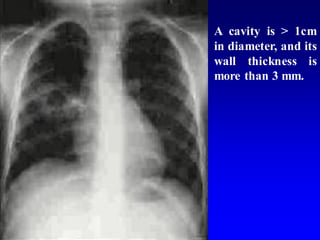 A cavity is > 1cm
in diameter, and its
wall thickness is
more than 3 mm.
 