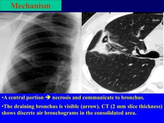 •A central portion  necrosis and communicate to bronchus.
•The draining bronchus is visible (arrow). CT (2 mm slice thickness)
shows discrete air bronchograms in the consolidated area.
Mechanism
 