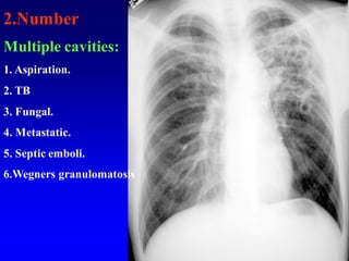 2.Number
Multiple cavities:
1. Aspiration.
2. TB
3. Fungal.
4. Metastatic.
5. Septic emboli.
6.Wegners granulomatosis
 