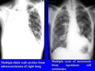 Multiple cysts of metastasis
from squamous cell
carcinoma.
Multiple thick wall cavities from
adenocarcinoma of right lung
 