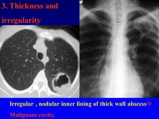 Irregular , nodular inner lining of thick wall abscess
Malignant cavity.
3. Thickness and
irregularity
 