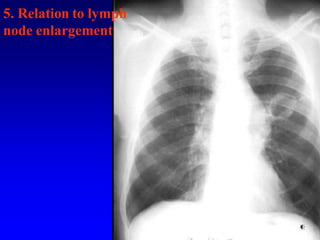 5. Relation to lymph
node enlargement
 
