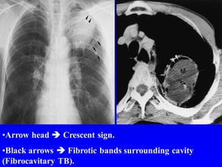 •Arrow head  Crescent sign.
•Black arrows  Fibrotic bands surrounding cavity
(Fibrocavitary TB).
 
