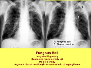 Fungous Ball
Long standing cavity
Containing round density (A)
Mobile density
Adjacent pleural reaction (B) - characteristic of aspergilloma
 