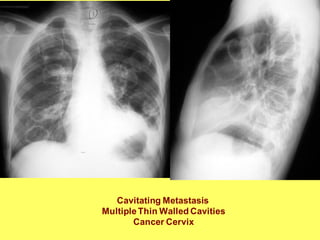 Cavitating Metastasis
MultipleThin Walled Cavities
Cancer Cervix
 