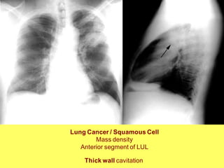 Lung Cancer / Squamous Cell
Mass density
Anterior segment of LUL
Thick wall cavitation
 