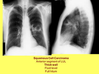 SquamousCell Carcinoma
Anterior segment of LUL
Thick wall
Fluid level
Full hilum
 