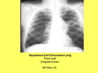 SquamousCell Carcinoma Lung
Thick wall
Irregular lumen
left hilar LN
 