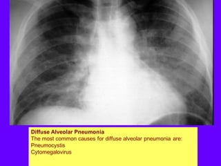 Diffuse Alveolar Pneumonia
The most common causes for diffuse alveolar pneumonia are:
Pneumocystis
Cytomegalovirus
 