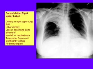 Consolidation Right
Upper Lobe /
Density in right upper lung
field
Lobar density
Loss of ascending aorta
silhouette
No shift of mediastinum
Transverse fissure not
significantly shifted
Air bronchogram
 