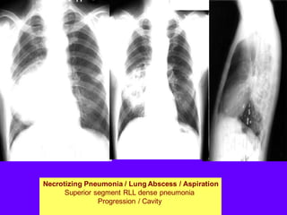 Necrotizing Pneumonia / Lung Abscess / Aspiration
Superior segment RLL dense pneumonia
Progression / Cavity
 