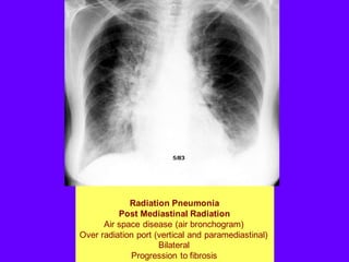Radiation Pneumonia
Post Mediastinal Radiation
Air space disease (air bronchogram)
Over radiation port (vertical and paramediastinal)
Bilateral
Progression to fibrosis
 