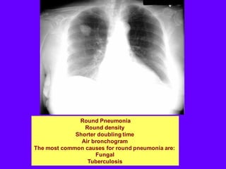 Round Pneumonia
Round density
Shorter doubling time
Air bronchogram
The most common causes for round pneumonia are:
Fungal
Tuberculosis
 