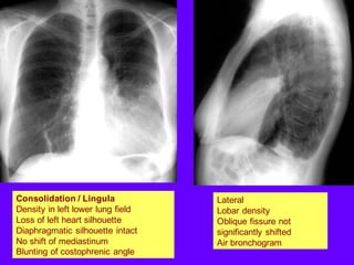 Consolidation / Lingula
Density in left lower lung field
Loss of left heart silhouette
Diaphragmatic silhouette intact
No shift of mediastinum
Blunting of costophrenic angle
Lateral
Lobar density
Oblique fissure not
significantly shifted
Air bronchogram
 