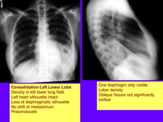 Consolidation Left Lower Lobe
Density in left lower lung field
Left heart silhouette intact
Loss of diaphragmatic silhouette
No shift of mediastinum
Pneumatocele
One diaphragm only visible
Lobar density
Oblique fissure not significantly
shifted
 