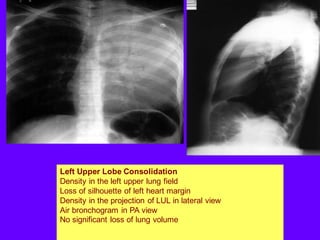 Left Upper Lobe Consolidation
Density in the left upper lung field
Loss of silhouette of left heart margin
Density in the projection of LUL in lateral view
Air bronchogram in PA view
No significant loss of lung volume
 