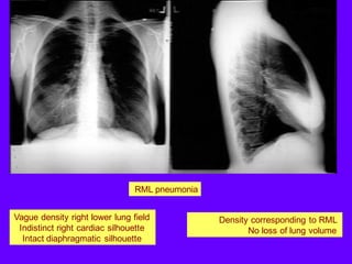 Vague density right lower lung field
Indistinct right cardiac silhouette
Intact diaphragmatic silhouette
Density corresponding to RML
No loss of lung volume
RML pneumonia
 