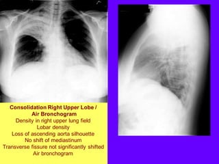Consolidation Right Upper Lobe /
Air Bronchogram
Density in right upper lung field
Lobar density
Loss of ascending aorta silhouette
No shift of mediastinum
Transverse fissure not significantly shifted
Air bronchogram
 