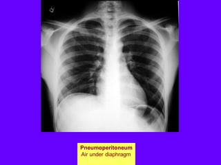 Pneumoperitoneum
Air under diaphragm
 