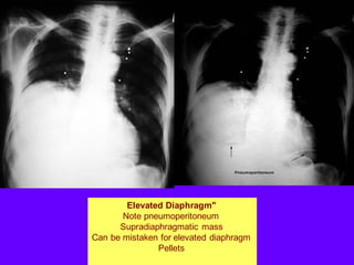 Elevated Diaphragm"
Note pneumoperitoneum
Supradiaphragmatic mass
Can be mistaken for elevated diaphragm
Pellets
 