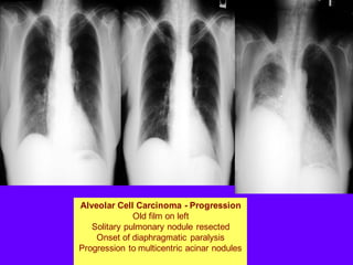 Alveolar Cell Carcinoma - Progression
Old film on left
Solitary pulmonary nodule resected
Onset of diaphragmatic paralysis
Progression to multicentric acinar nodules
 