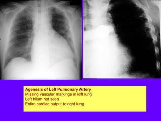 Agenesis of Left Pulmonary Artery
Missing vascular markings in left lung
Left hilum not seen
Entire cardiac output to right lung
 