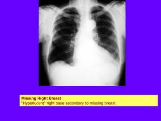 Missing Right Breast
"Hyperlucent" right base secondary to missing breast.
 