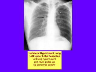 Unilateral Hyperlucent Lung
Left Upper Lobe Resection
Left lung hyper lucent
Left hilum pulled up
No abnormal density
 