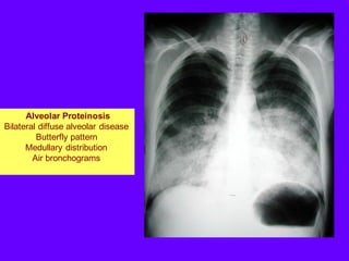 Alveolar Proteinosis
Bilateral diffuse alveolar disease
Butterfly pattern
Medullary distribution
Air bronchograms
 
