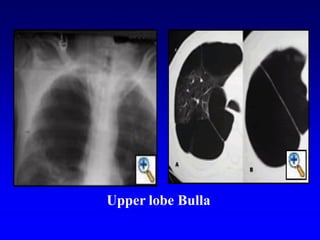 Upper lobe Bulla
 