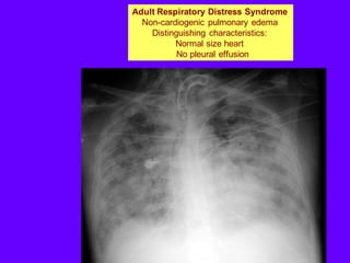 Adult Respiratory Distress Syndrome
Non-cardiogenic pulmonary edema
Distinguishing characteristics:
Normal size heart
No pleural effusion
 