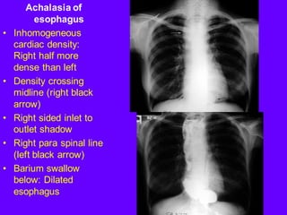 Achalasia of
esophagus
• Inhomogeneous
cardiac density:
Right half more
dense than left
• Density crossing
midline (right black
arrow)
• Right sided inlet to
outlet shadow
• Right para spinal line
(left black arrow)
• Barium swallow
below: Dilated
esophagus
 