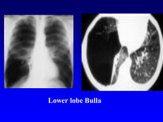 Lower lobe Bulla
 