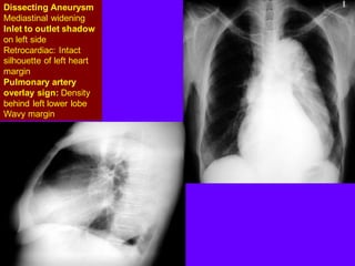 Dissecting Aneurysm
Mediastinal widening
Inlet to outlet shadow
on left side
Retrocardiac: Intact
silhouette of left heart
margin
Pulmonary artery
overlay sign: Density
behind left lower lobe
Wavy margin
 
