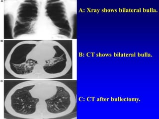 A: Xray shows bilateral bulla.
B: CT shows bilateral bulla.
C: CT after bullectomy.
 