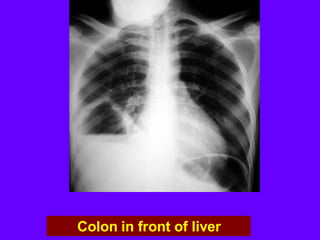 Colon in front of liver
 