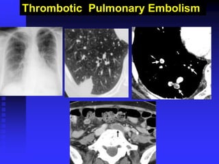 Thrombotic Pulmonary Embolism
 