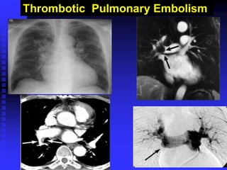 Thrombotic Pulmonary Embolism
 
