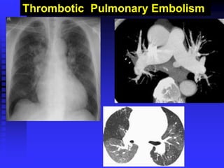 Thrombotic Pulmonary Embolism
 