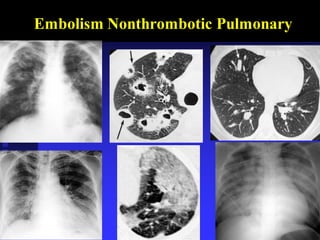 Embolism Nonthrombotic Pulmonary
 