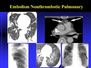 Embolism Nonthrombotic Pulmonary
 