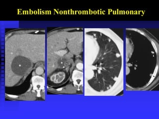 Embolism Nonthrombotic Pulmonary
 