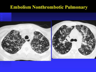 Embolism Nonthrombotic Pulmonary
 