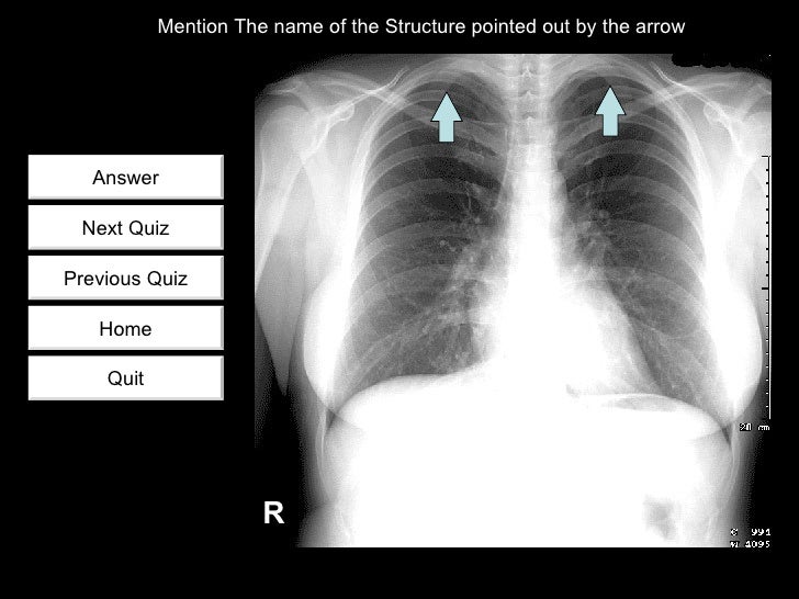 Chest radiology quiz