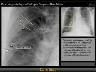 Chest Review (#1 - 76).ppt